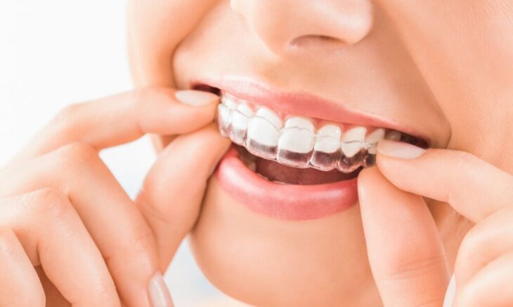 Invisalign For Straightening Teeth